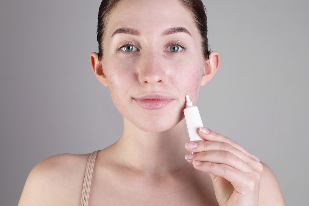 Johns Creek, GA compounded acne medication.